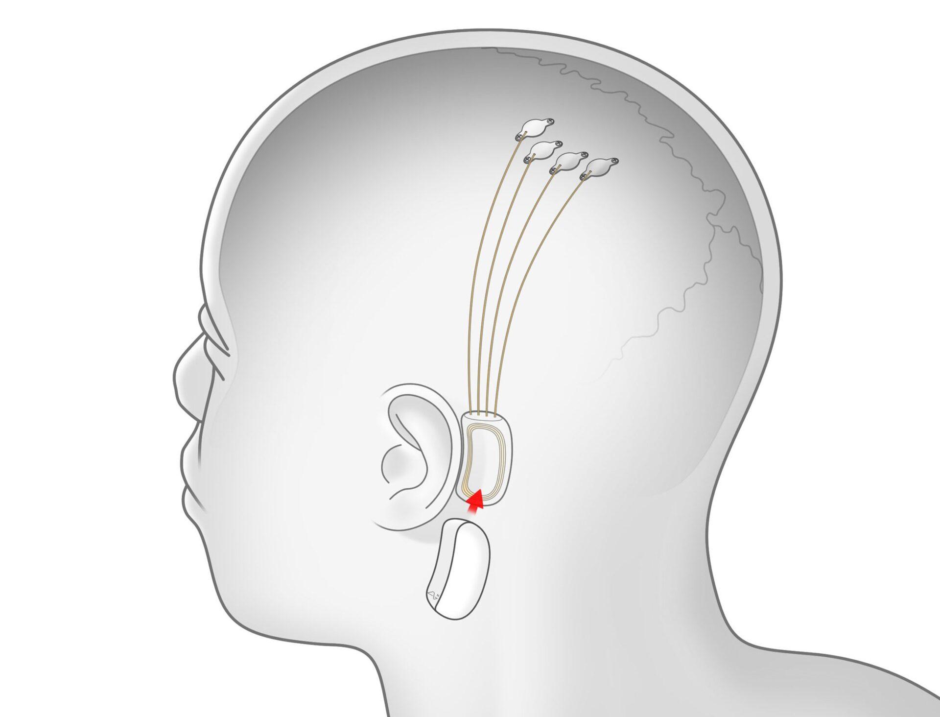 Neuralink Hayvan İşkencesi İddialarıyla Karşı Karşıya